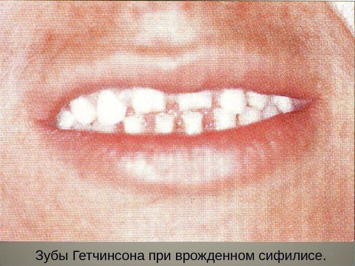 49 Зубы Гетчинсона при врожденном сифилисе. 