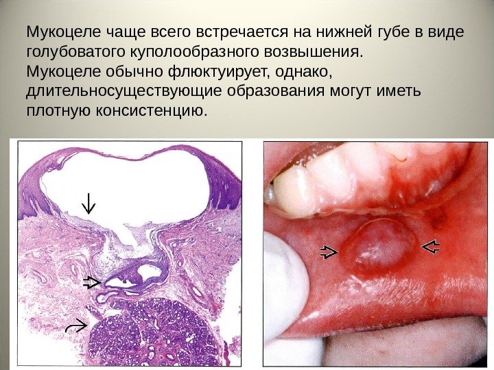 Мукоцеле чаще всего встречается на нижней губе в виде голубоватого куполообразного возвышения.  Мукоцеле