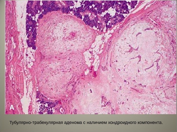 Тубулярно-трабекулярная аденома с наличием хондроидного компонента.  