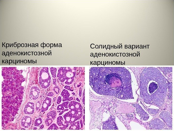 Криброзная форма аденокистозной карциномы Солидный вариант аденокистозной карциномы 