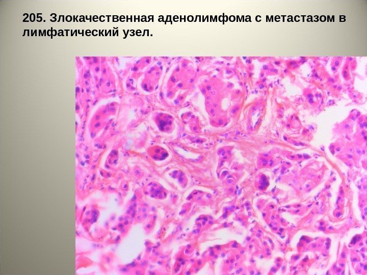 2 0 5. Злокачественная аденолимфома с метастазом в лимфатический узел.  