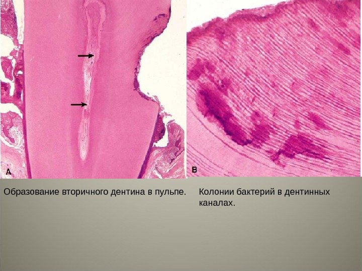 Образование вторичного дентина в пульпе. Колонии бактерий в дентинных каналах.  