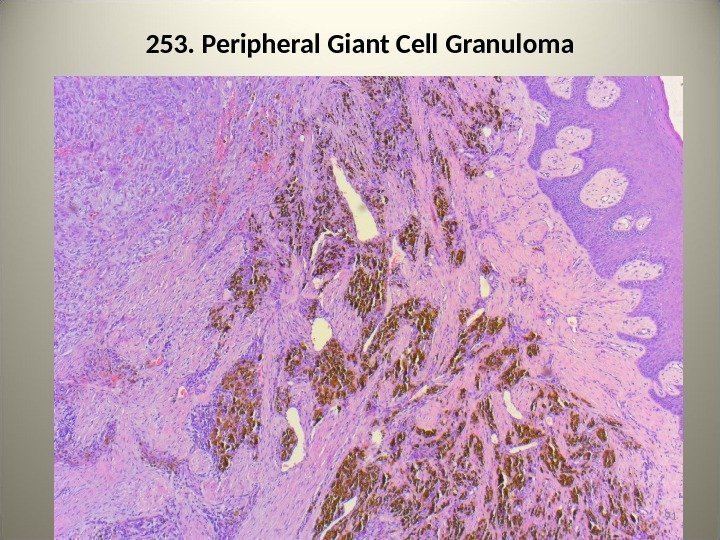 253. Peripheral Giant Cell Granuloma 91 