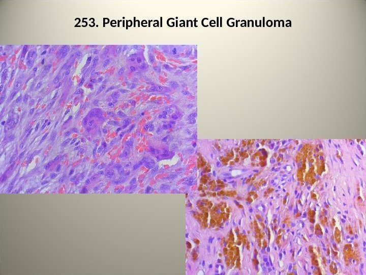 253. Peripheral Giant Cell Granuloma 92 