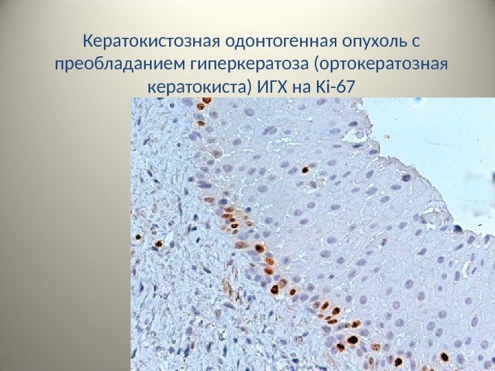 35 Кератокистозная одонтогенная опухоль с преобладанием гиперкератоза (ортокератозная кератокиста) ИГХ на Ki-67 