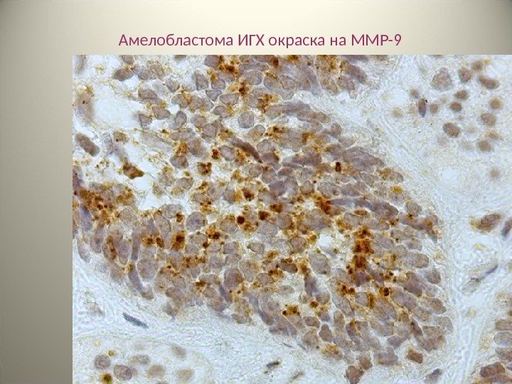 43 Амелобластома ИГХ окраска на MMP-9 