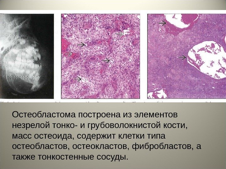 Остеобластома построена из элементов незрелой тонко- и грубоволокнистой кости,  масс остеоида, содержит клетки