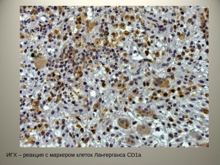 ИГХ – реакция с маркером клеток Лангерганса CD 1 a 