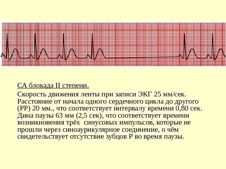   СА блокада II степени.  Скорость движения ленты при записи ЭКГ 25