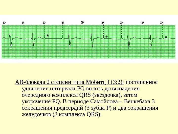   АВ-блокада 2 степени типа Мобитц I (3: 2):  постепенное удлинение интервала