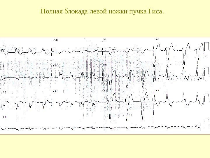   Полная блокада левой ножки пучка Гиса.  