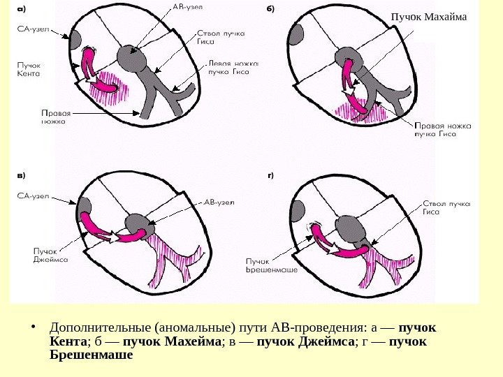   • Дополнительные (аномальные) пути АВ-проведения: а — пучок Кента ; б —