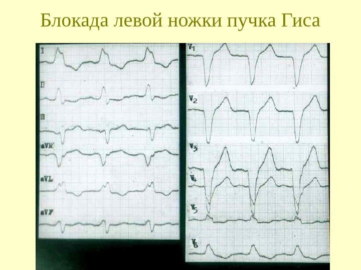   Блокада левой ножки пучка Гиса 