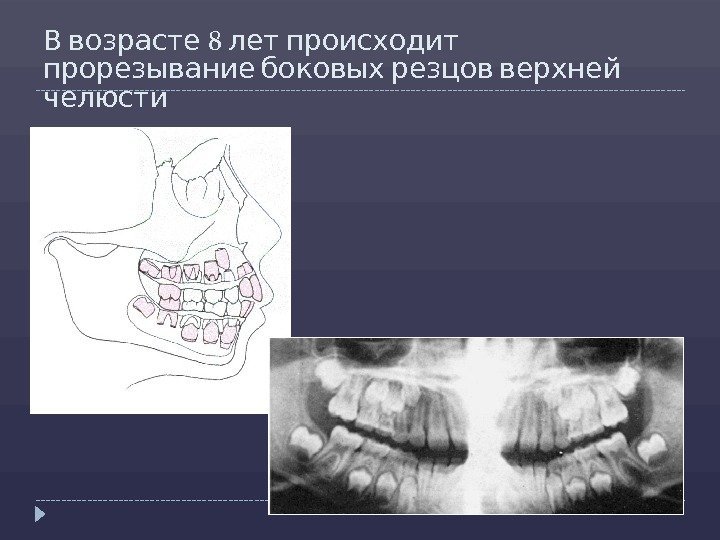   8 В возрасте лет происходит   прорезывание боковых резцов верхней челюсти