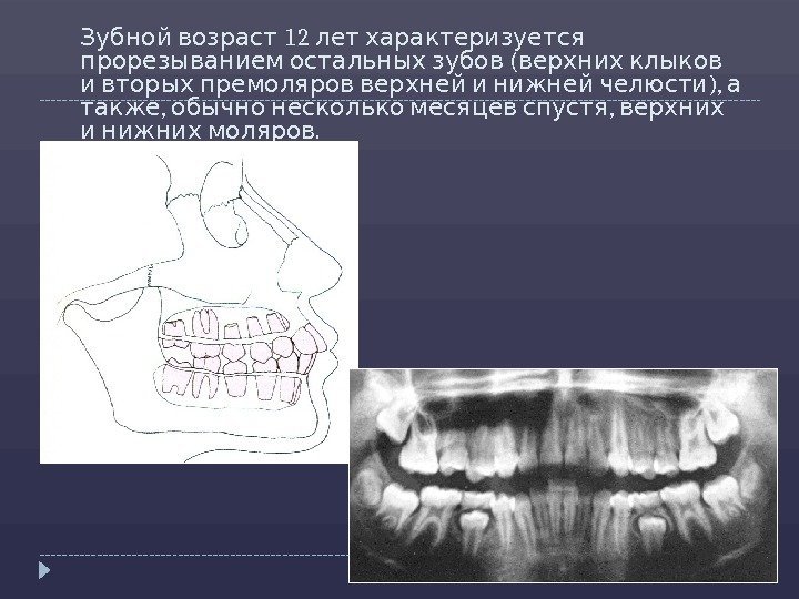   12 Зубной возраст лет характеризуется ( прорезыванием остальных зубов верхних клыков 