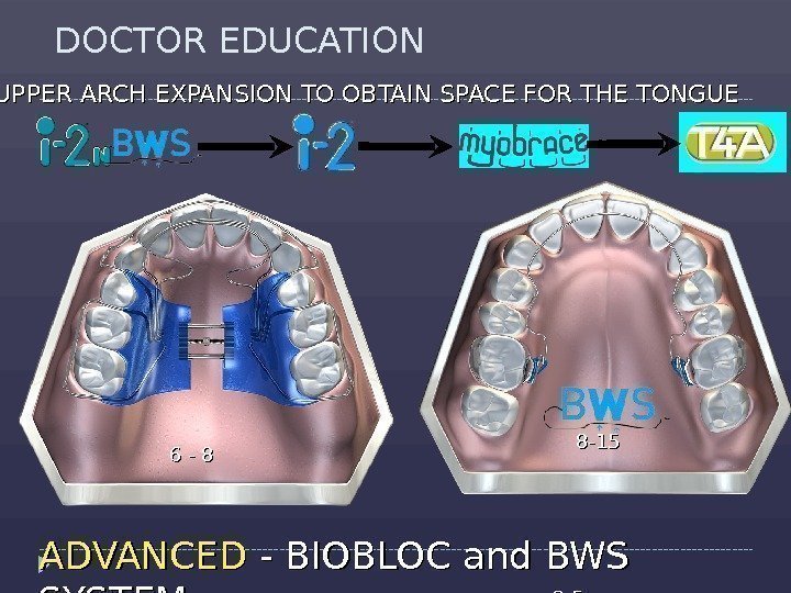 DOCTOR EDUCATION ADVANCED - BIOBLOC and BWS SYSTEM 2 -52 -5 UPPER ARCH EXPANSION
