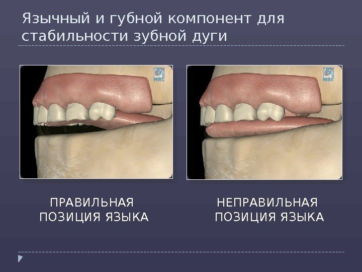 Язычный и губной компонент для стабильности зубной дуги ПРАВИЛЬНАЯ ПОЗИЦИЯ ЯЗЫКА НЕПРАВИЛЬНАЯ ПОЗИЦИЯ ЯЗЫКА