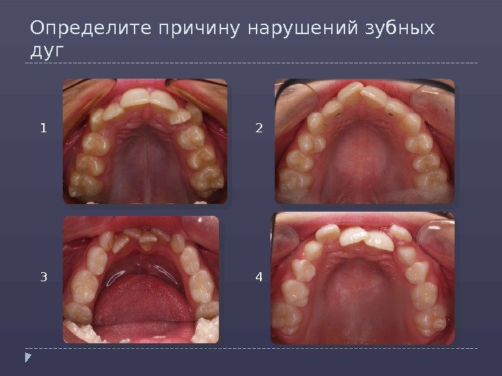 Определите причину нарушений зубных дуг 1 2 3 4  