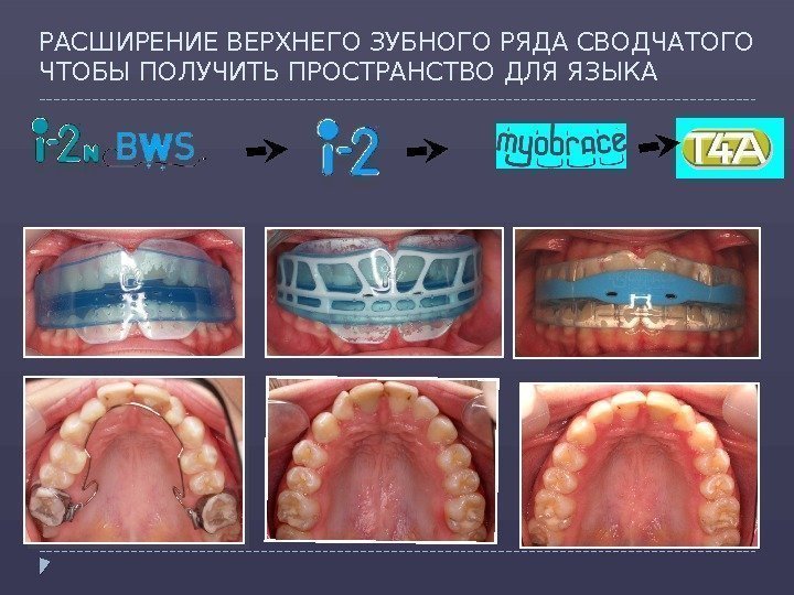 РАСШИРЕНИЕ ВЕРХНЕГО ЗУБНОГО РЯДА СВОДЧАТОГО ЧТОБЫ ПОЛУЧИТЬ ПРОСТРАНСТВО ДЛЯ ЯЗЫКА   