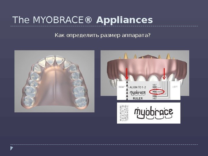 The MYOBRACE ® Appliances Как определить размер аппарата?  