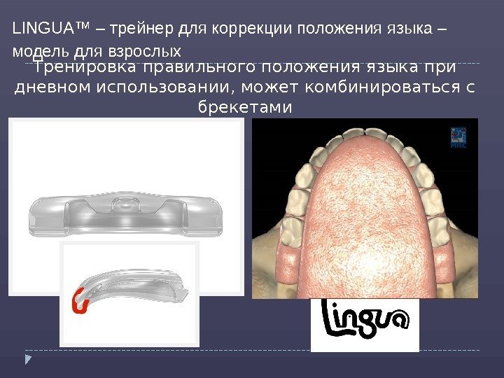 Тренировка правильного положения языка при дневном использовании, может комбинироваться с брекетами. LINGUA™ – трейнер