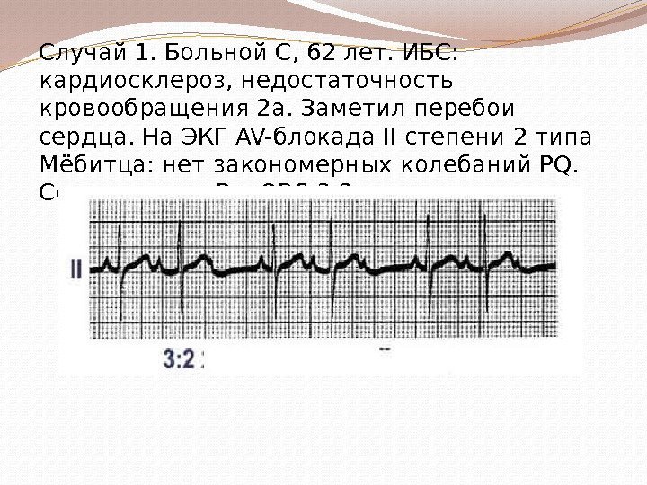 Случай 1. Больной С, 62 лет. ИБС:  кардиосклероз, недостаточность кровообращения 2 а. Заметил