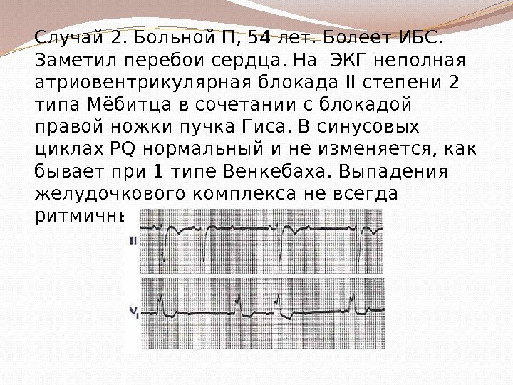 Случай 2. Больной П, 54 лет. Болеет ИБС.  Заметил перебои сердца. На ЭКГ