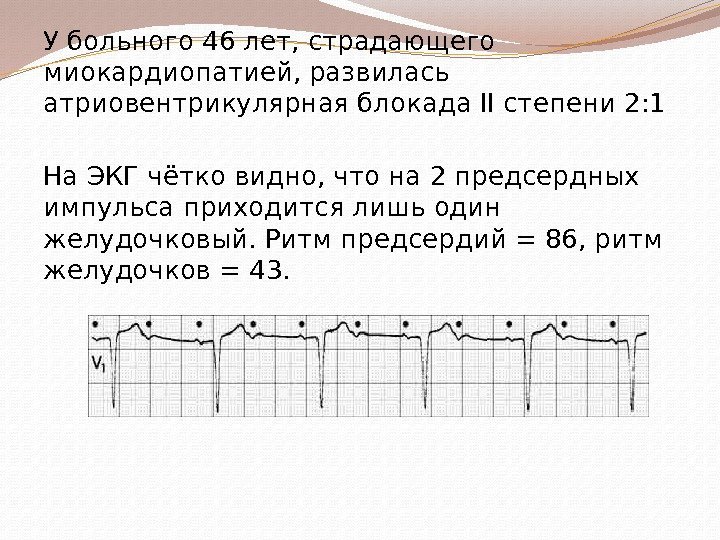 У больного 46 лет, страдающего миокардиопатией, развилась атриовентрикулярная блокада II степени 2: 1 На