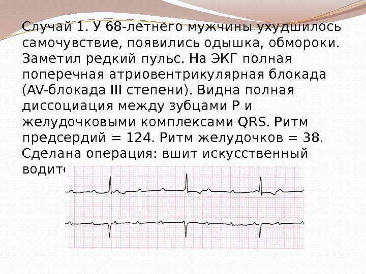 Случай 1. У 68 -летнего мужчины ухудшилось самочувствие, появились одышка, обмороки.  Заметил редкий