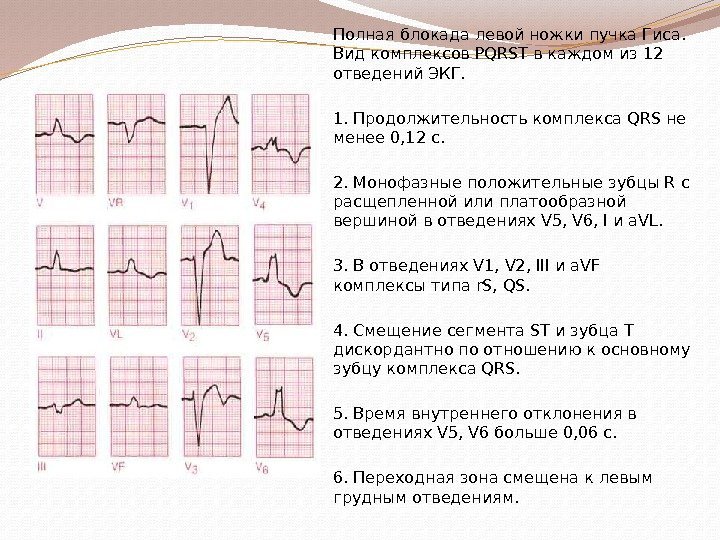 Полная блокада левой ножки пучка Гиса.  Вид комплексов PQRST в каждом из 12