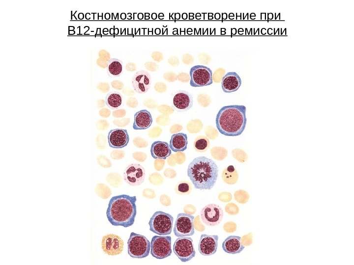 Костномозговое кроветворение при В 12 -дефицитной анемии в ремиссии 