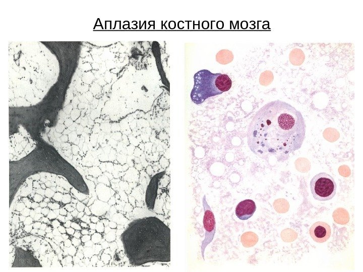 Аплазия костного мозга 