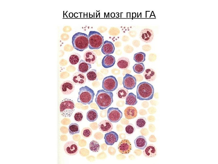 Костный мозг при ГА 