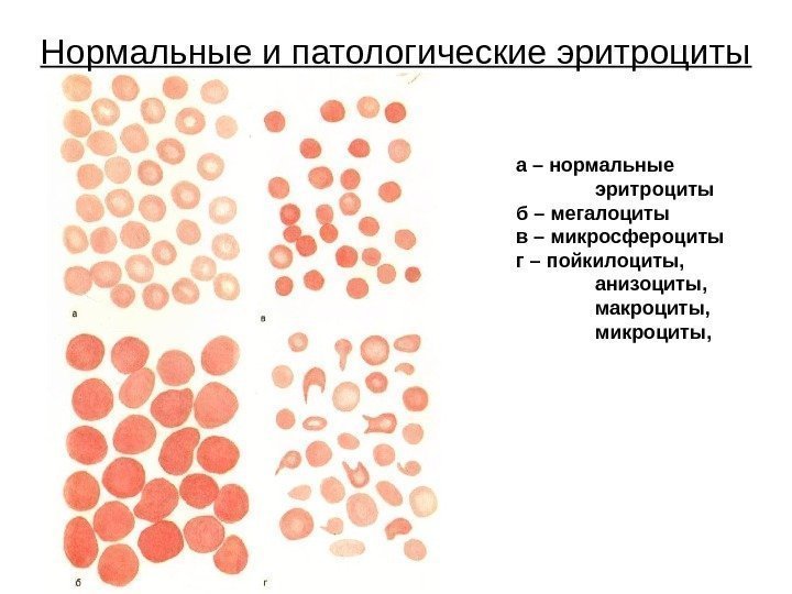 Нормальные и патологические эритроциты а – нормальные эритроциты б – мегалоциты в – микросфероциты