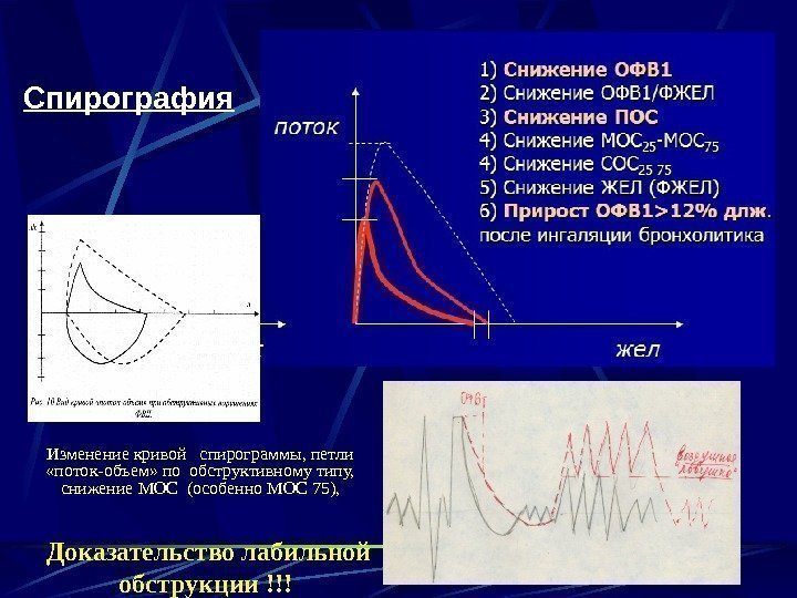 Спирография Изменение кривой  спирограммы, петли  «поток-объем» по обструктивному типу,  снижение МОС