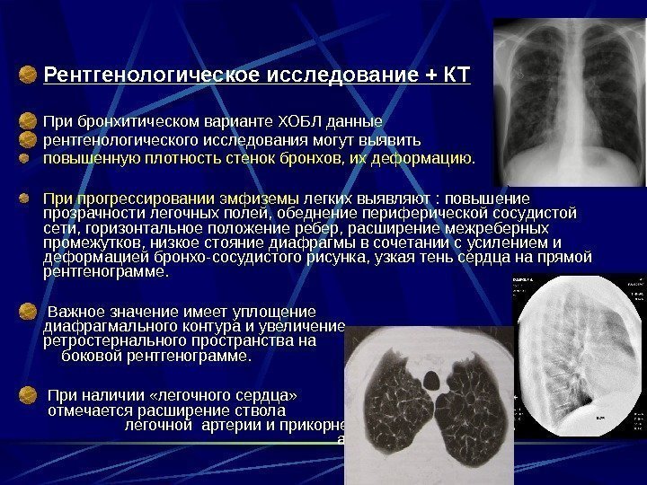 Рентгенологическое исследование + КТ При бронхитическом варианте ХОБЛ данные рентгенологического исследования могут выявить повышенную