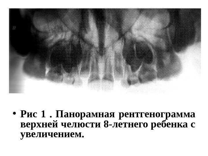  • Рис 1 .  Панорамная рентгенограмма верхней челюсти 8 -летнего ребенка с