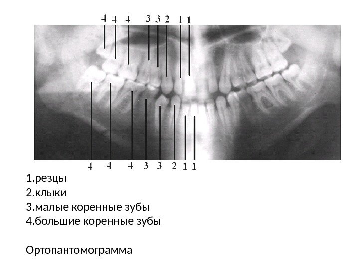 1. резцы 2. клыки 3. малые коренные зубы 4. большие коренные зубы Ортопантомограмма 