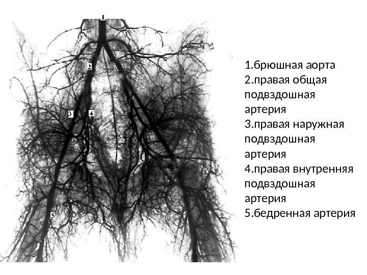 1. брюшная аорта 2. правая общая подвздошная артерия 3. правая наружная подвздошная артерия 4.