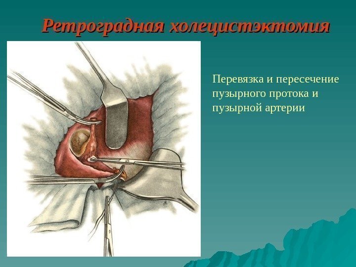   Ретроградная холецистэктомия Перевязка и пересечение пузырного протока  и пузырной артерии 