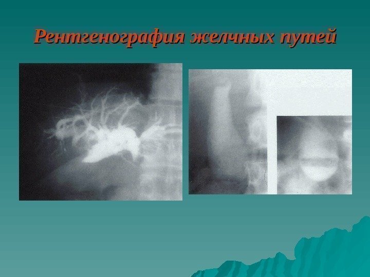   Рентгенография желчных путей 