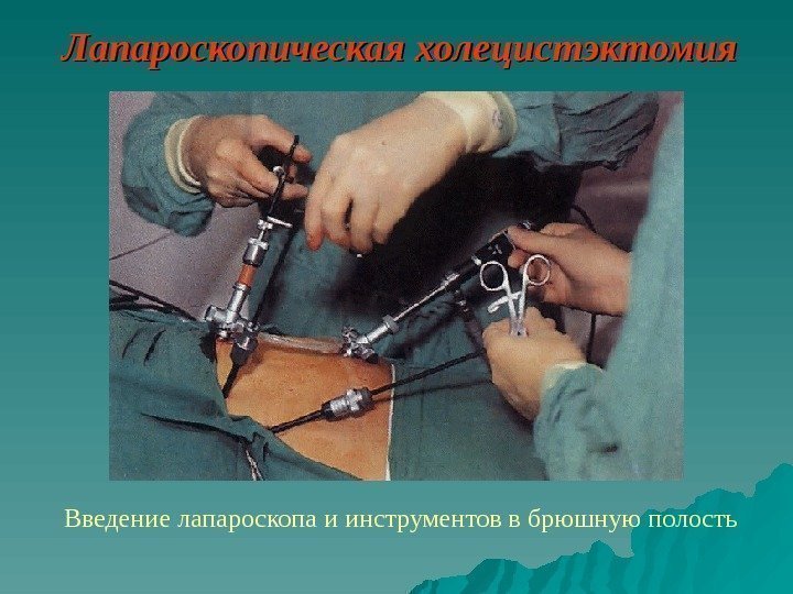   Лапароскопическая холецистэктомия Введение лапароскопа и инструментов в брюшную полость 