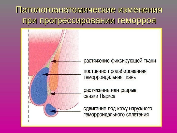   Патологоанатомические изменения при прогрессировании геморроя 