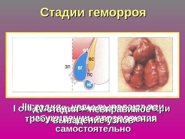   Стадии геморроя II стадия – – узлы видны только при эндоскопии. IIII