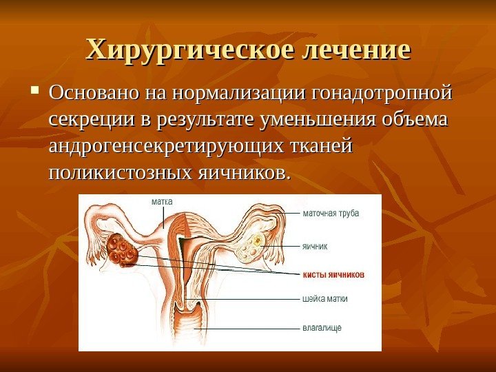 Хирургическое лечение Основано на нормализации гонадотропной секреции в результате уменьшения объема андрогенсекретирующих тканей поликистозных