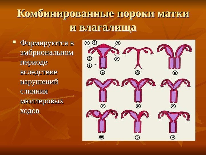 Комбинированные пороки матки и влагалища Формируются в эмбриональном периоде вследствие нарушений слияния мюллеровых ходов