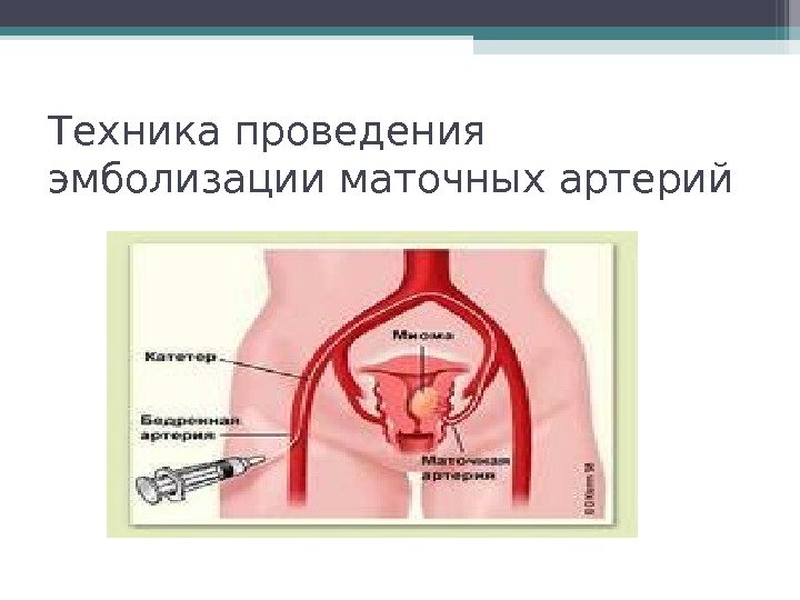 Техника проведения эмболизации маточных артерий   