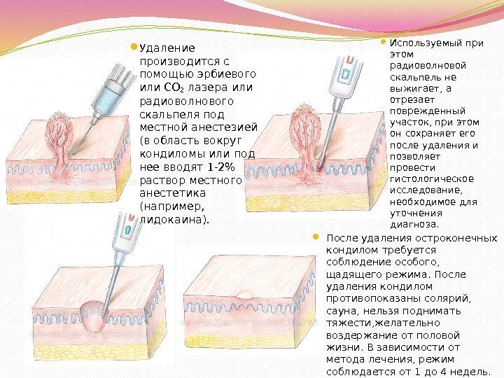  Удаление производится с помощью эрбиевого или CO 2 лазера или радиоволнового скальпеля под