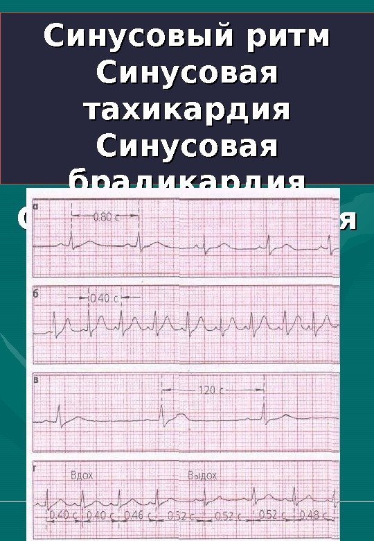   Синусовый ритм Синусовая тахикардия Синусовая брадикардия Синусовая аритмия 