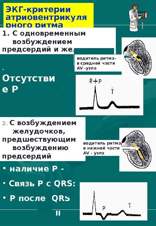   ЭКГ-критерии атриовентрикуля рного ритма 2.  С возбуждением желудочков, предшествующим возбуждению предсердий